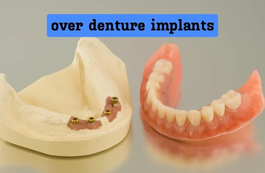 over denture implants