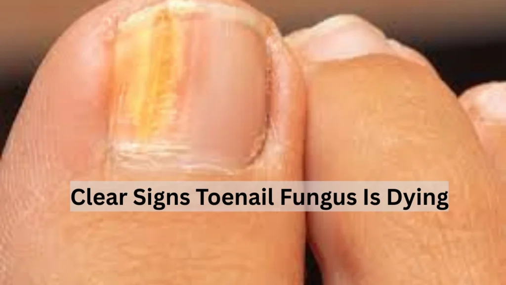 Clear Signs Toenail Fungus Is Dying