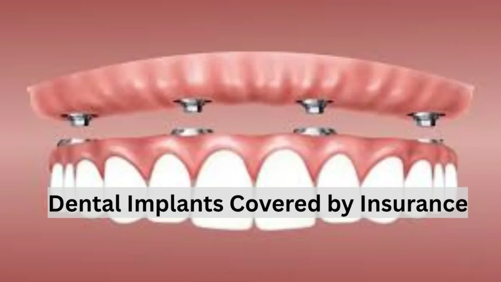 Dental Implants Covered by Insurance